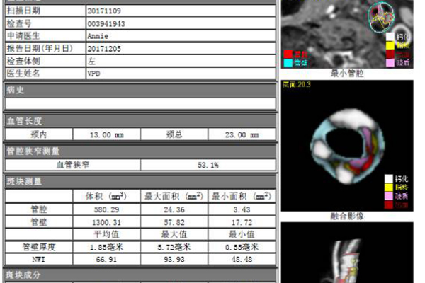 核磁共振動脈硬化(huà)斑塊分(fēn)析系統（MRI-PlaqueView）